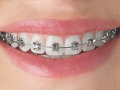 Edelstahlbrackets