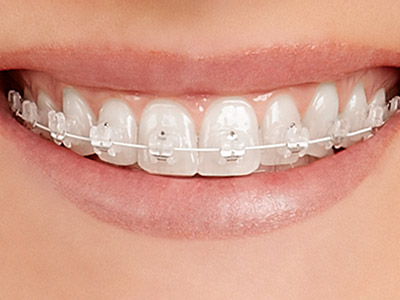 Zahnfarbene Keramikbrackets